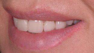 Image example of teeth before gummy smile makeover 8