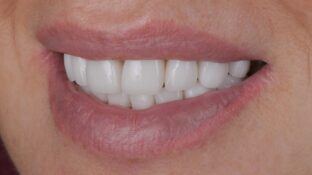 Image example of teeth after gummy smile makeover 8