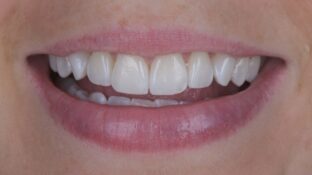 Image example of teeth after tooth contouring 7