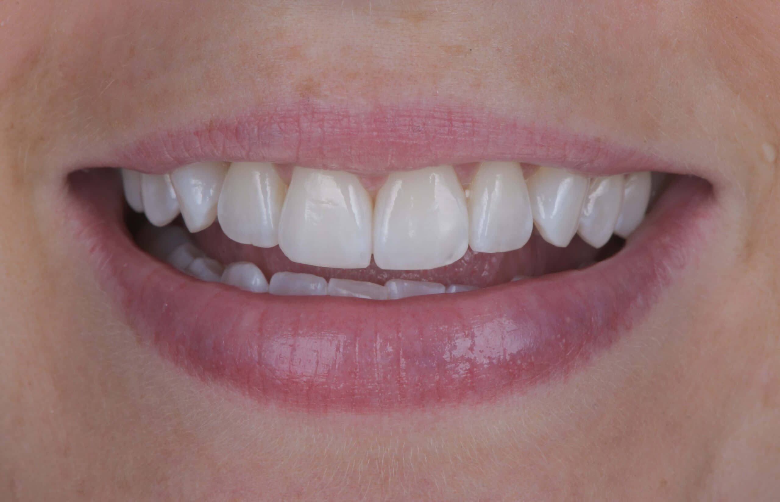 Tooth Contouring | Marylebone Smile Clinic
