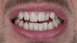 Image example of teeth after tooth contouring 3