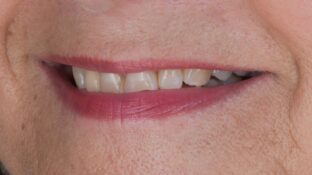 Image example of teeth before gummy smile makeover 7