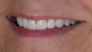 Image example of teeth after gummy smile makeover 7