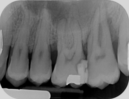 X-Ray of Teeth