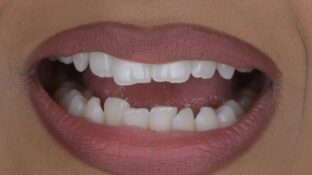 Image example of teeth after tooth contouring 4