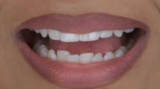 Image example of teeth after tooth contouring 6