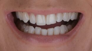 Image example of teeth after tooth contouring 2