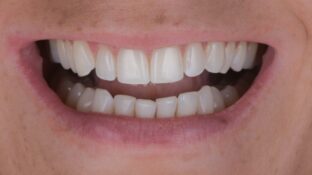 Image example of teeth after tooth contouring 5