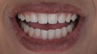 Image example of teeth after tooth contouring