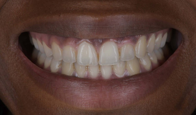 Photo before Marylebone Clinic dental gummy smile makeover