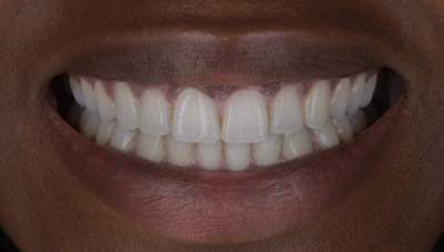 Photo after Marylebone Clinic dental gummy smile makeover
