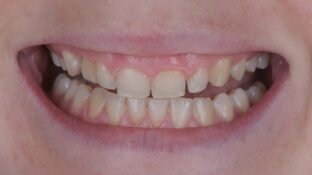 Image example of teeth before gummy smile makeover 3