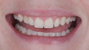 Image example of teeth after gummy smile makeover 3