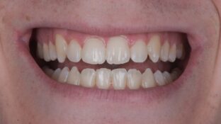 Image example of teeth before gummy smile makeover 6