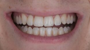 Image example of teeth after gummy smile makeover 6