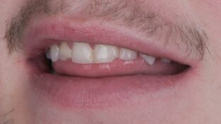 Image example of teeth after gummy smile makeover 5