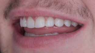 Image example of teeth after gummy smile makeover