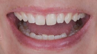 Image example of teeth before gummy smile makeover