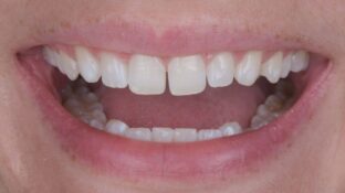 Image example of teeth after gummy smile makeover 4