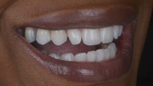 Image example of teeth after gummy smile makeover 2