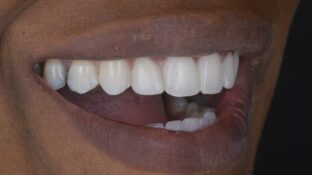 Image example of teeth before gummy smile makeover 2