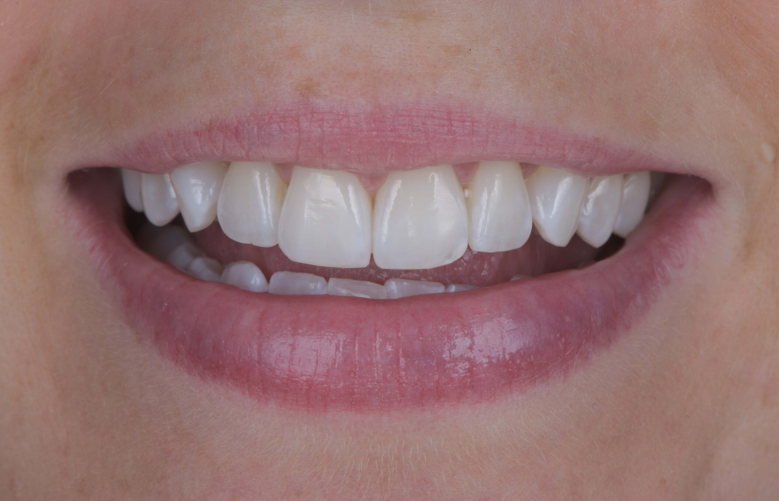 Photo after Marylebone Clinic dental mini smile makeover