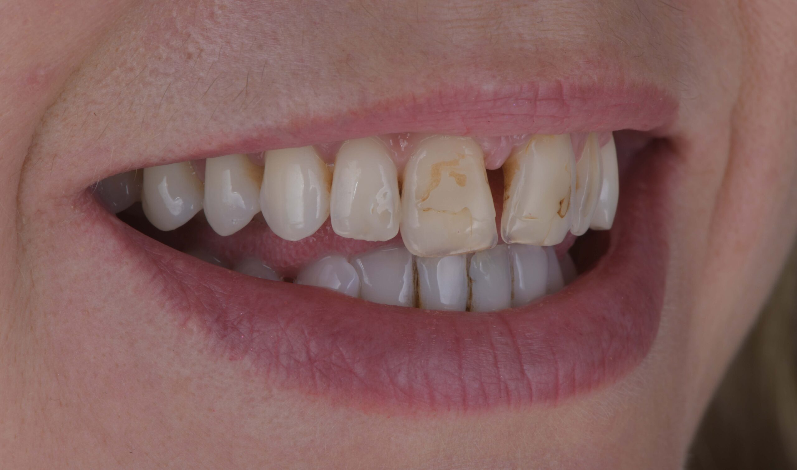 Photo before Marylebone Clinic dental implants