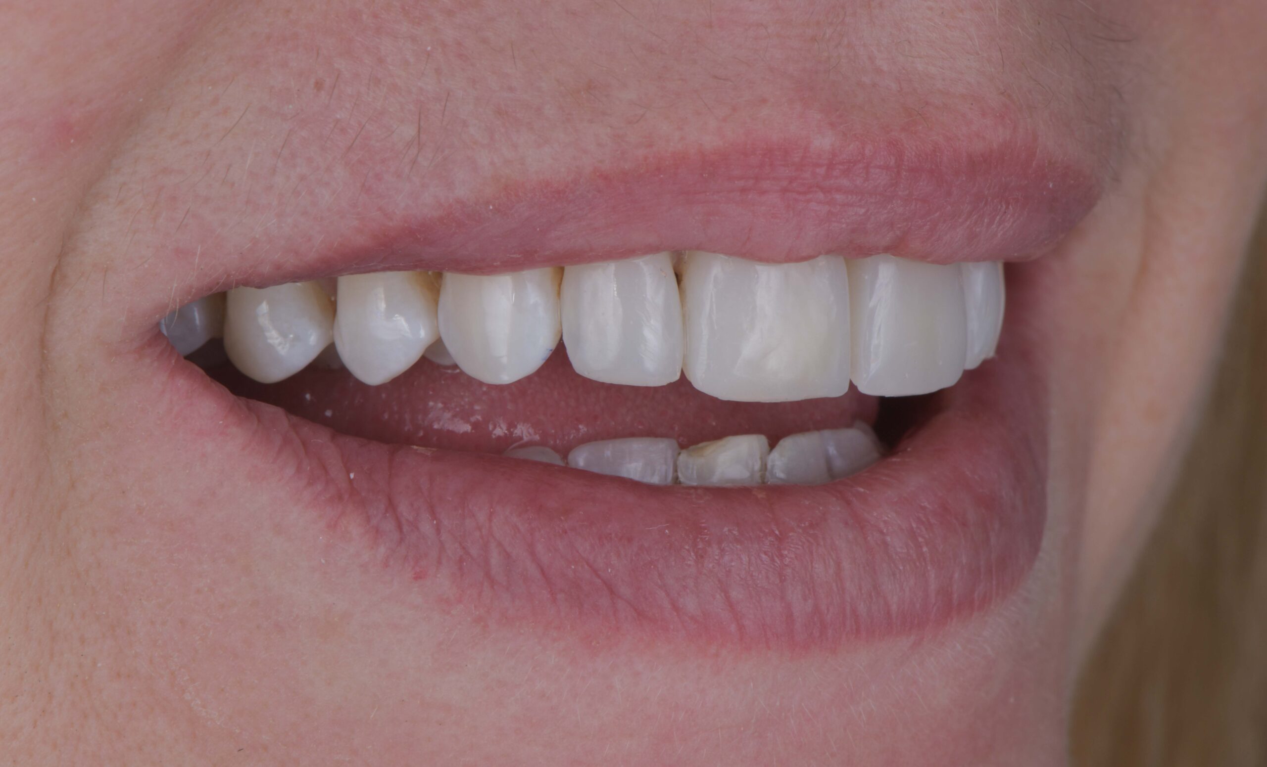 Photo after Marylebone Clinic dental implants