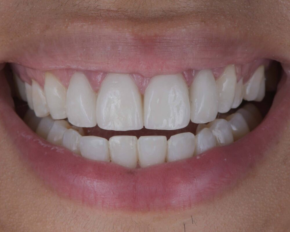 discoloured-teeth-that-are-now-white-after-veneers