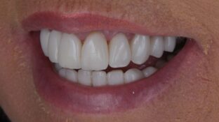 overbite-teeth-after-veneers