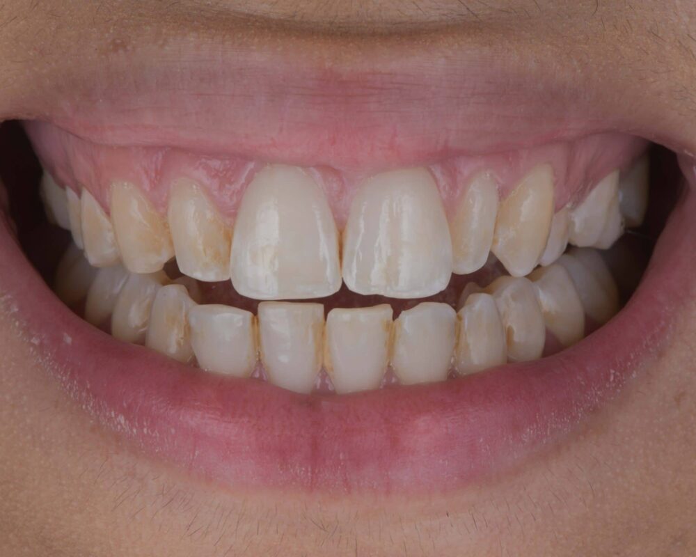 discoloured-teeth-before-veneers