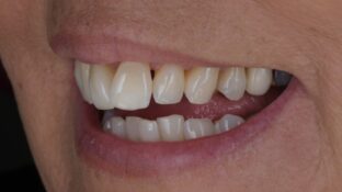 overbite-teeth-before-veneers
