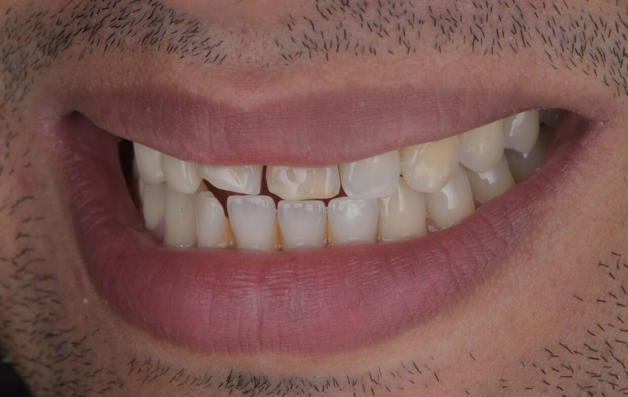 man-smiling-before-receiving-treatment-to-his-teeth