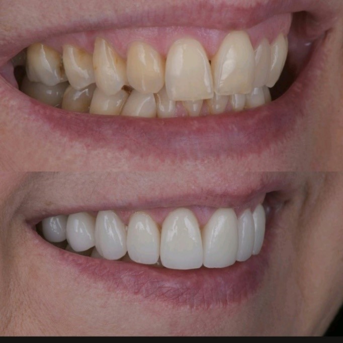 before-and-after-comparison-of-ceramic-veneer-teeth