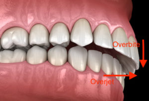 diagram-of-overbite-teeth