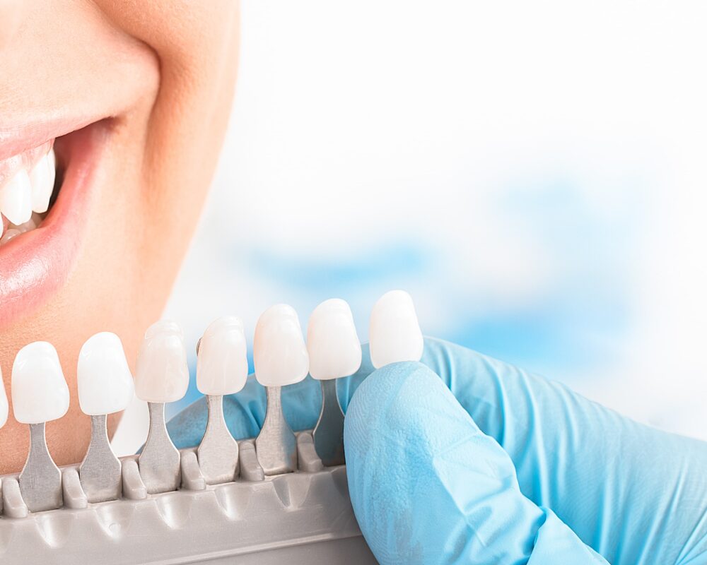 Ceramic Veneers vs Composite Bonding The Pros and Co Marylebone