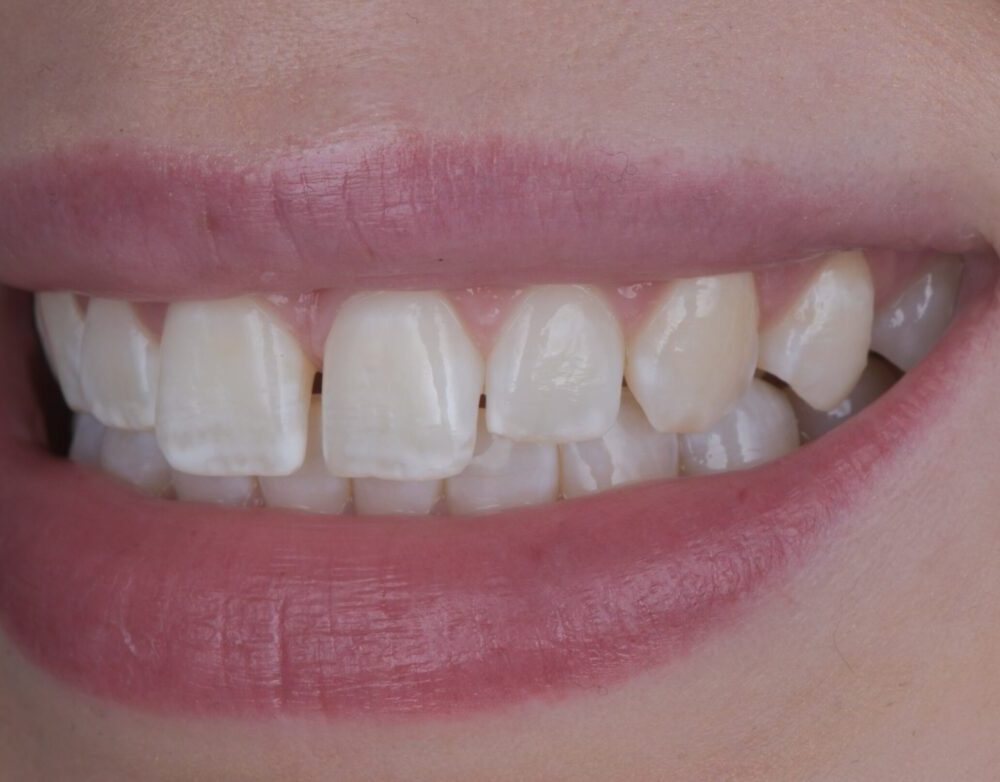 teeth-before-veneer-treatment-for-fluorosis
