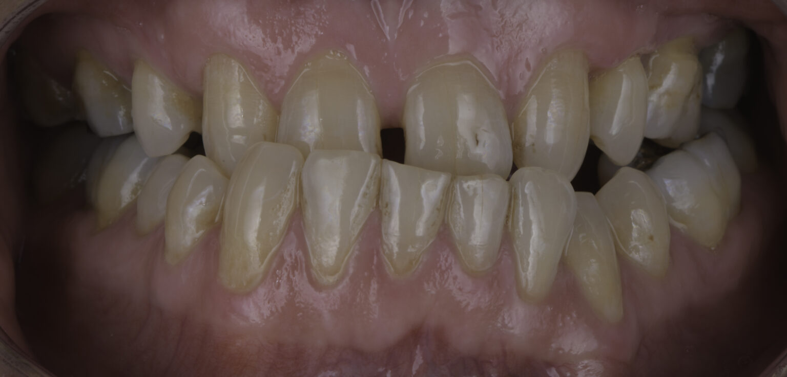 Veneers for Underbites Are Veneers Viable for Underbites?