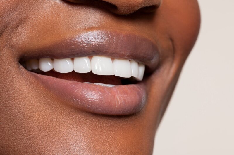 woman-with-a-perfect-smile-from-veneers