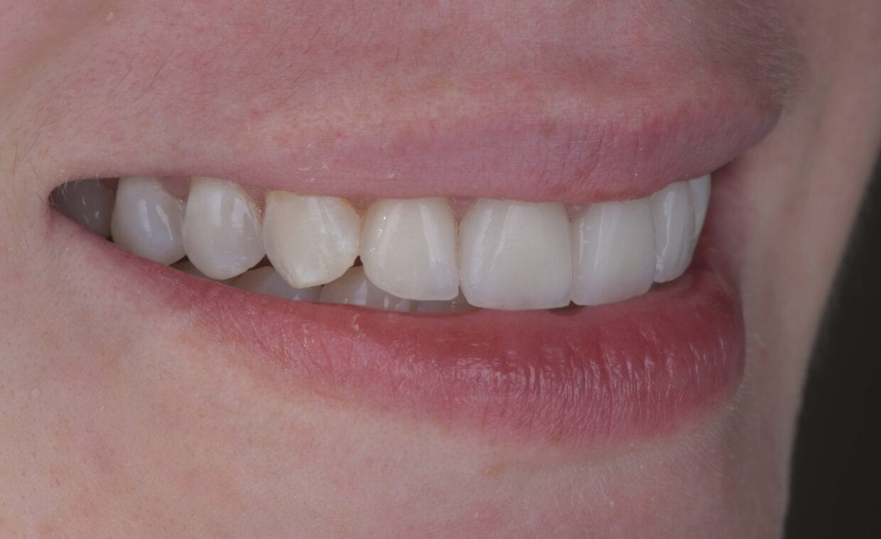 Single Tooth Veneers Should You Get a Veneer on One Tooth?