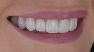 teeth-after-porcelain-veneers