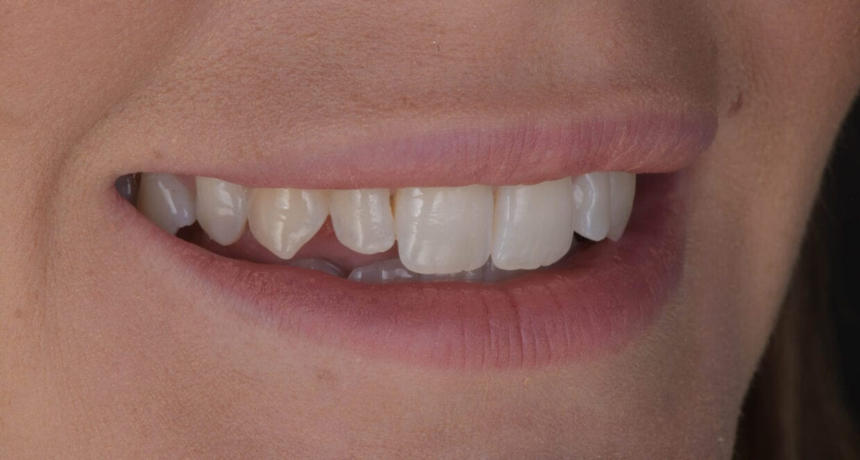 teeth-before-porcelain-veneers