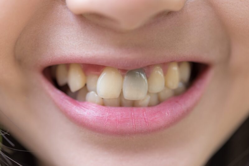 teeth-with-tetracycline-stains
