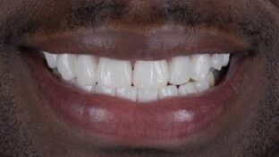 after a cosmetic dentistry