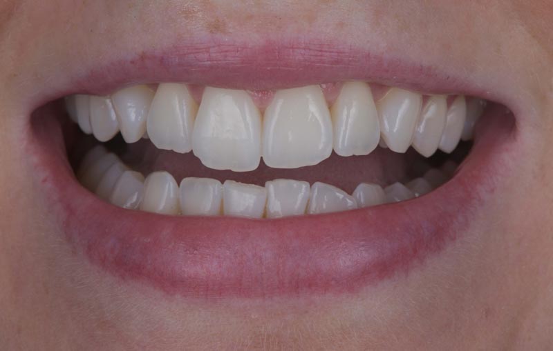 Photo before Marylebone Clinic dental mini smile makeover