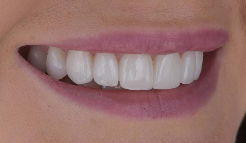 Photo after Marylebone Clinic dental veneers