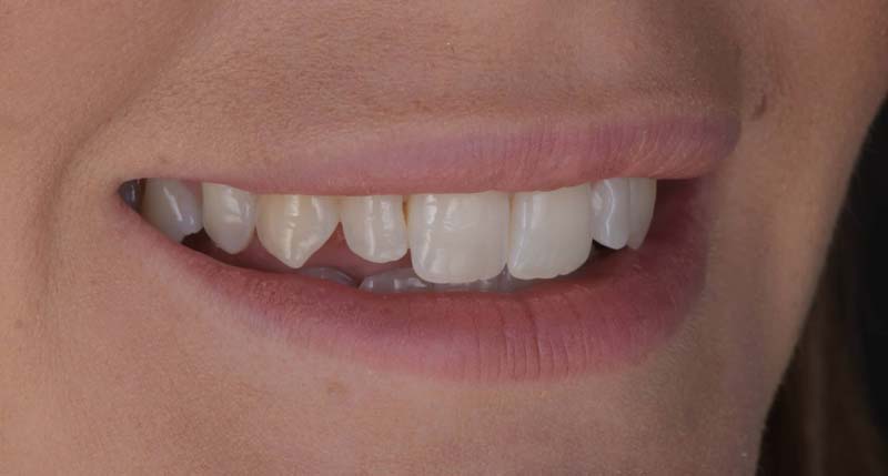 Photo before Marylebone Clinic dental veneers