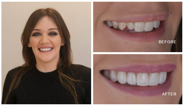 veneers London 1