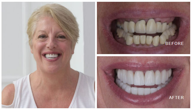 veneers London 2