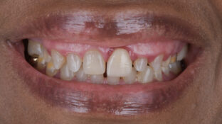 Before - Sahil Patel